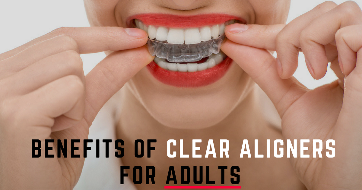 Benefits Of Clear Aligners For Adults In Chino Ca Hope Family Dentistry